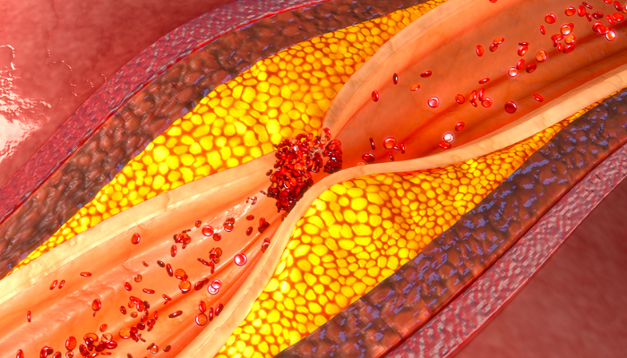 Diabète : un nouveau biomarqueur sanguin prédit le risque cardiovasculaire à dix ans