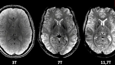 Imagerie médicale d'un cerveau humain